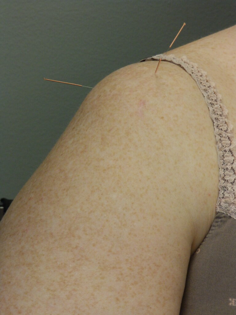 Acupuncture in shoulder