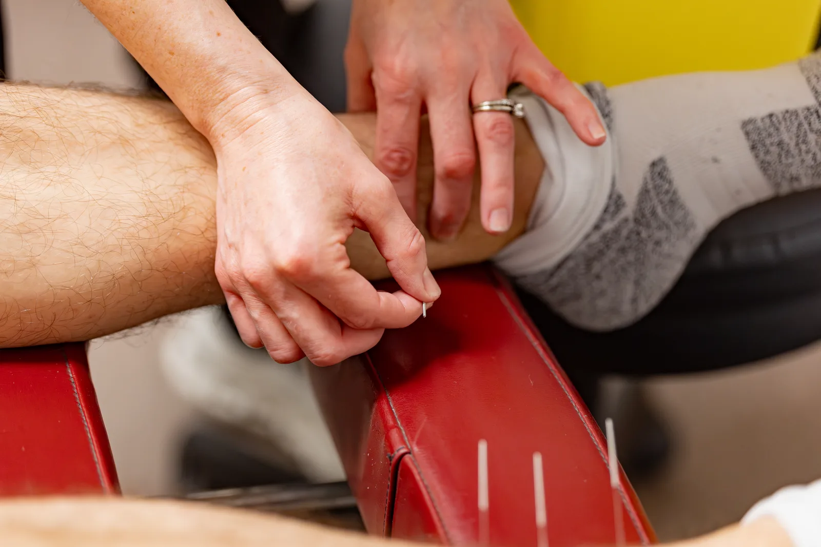 Acupuncture 2 – physiotherapy services at Eramosa Physiotherapy Associates, HPC